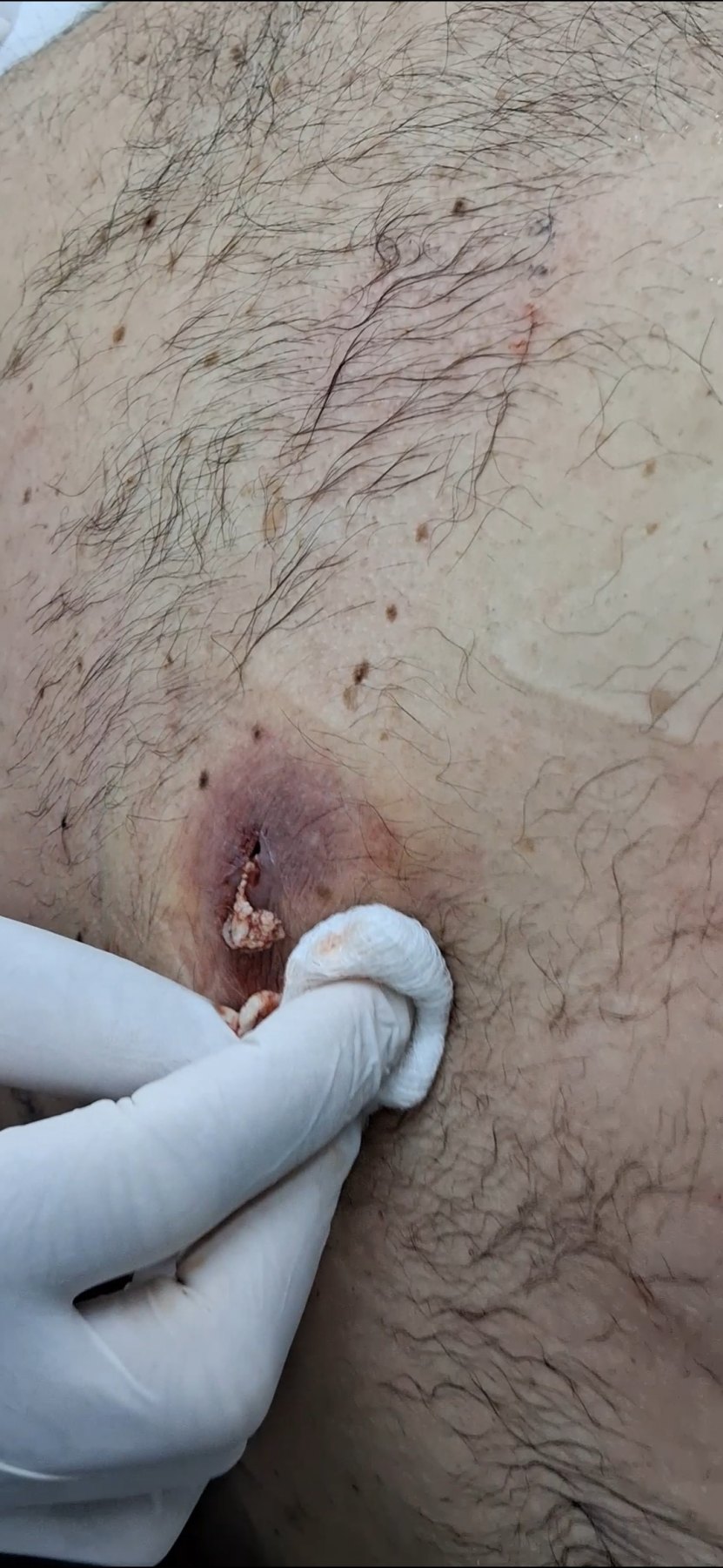 Abscess: before image