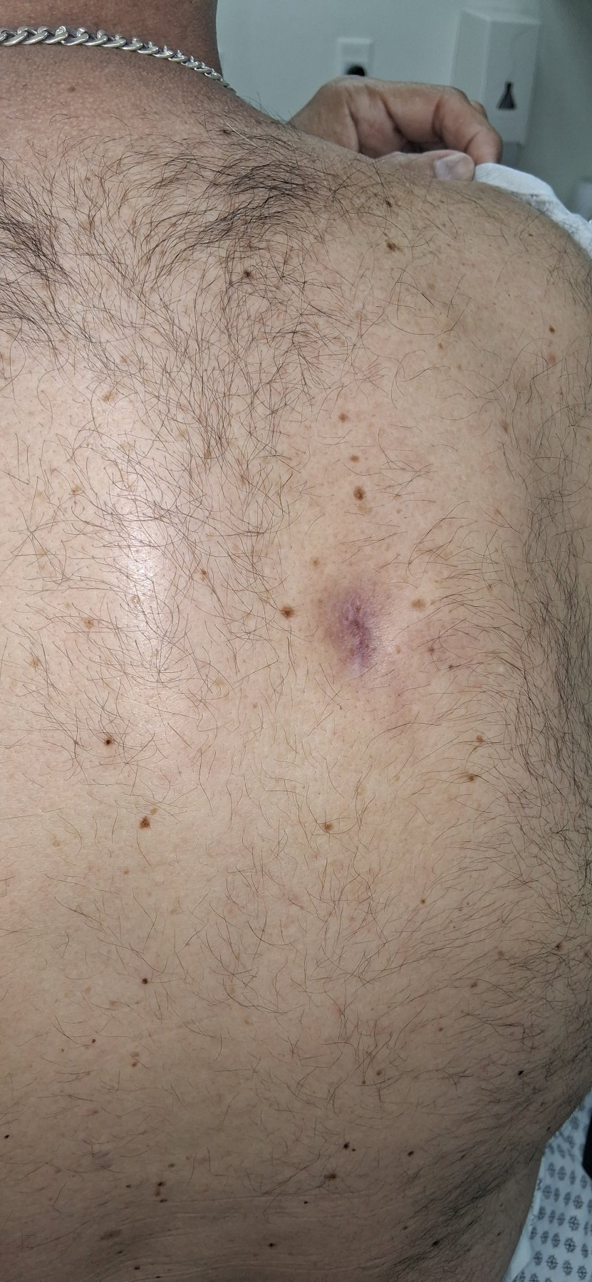 Abscess: after image
