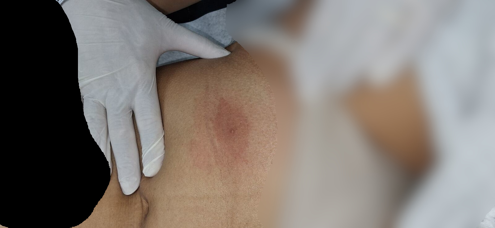 Abscess furuncle: before image
