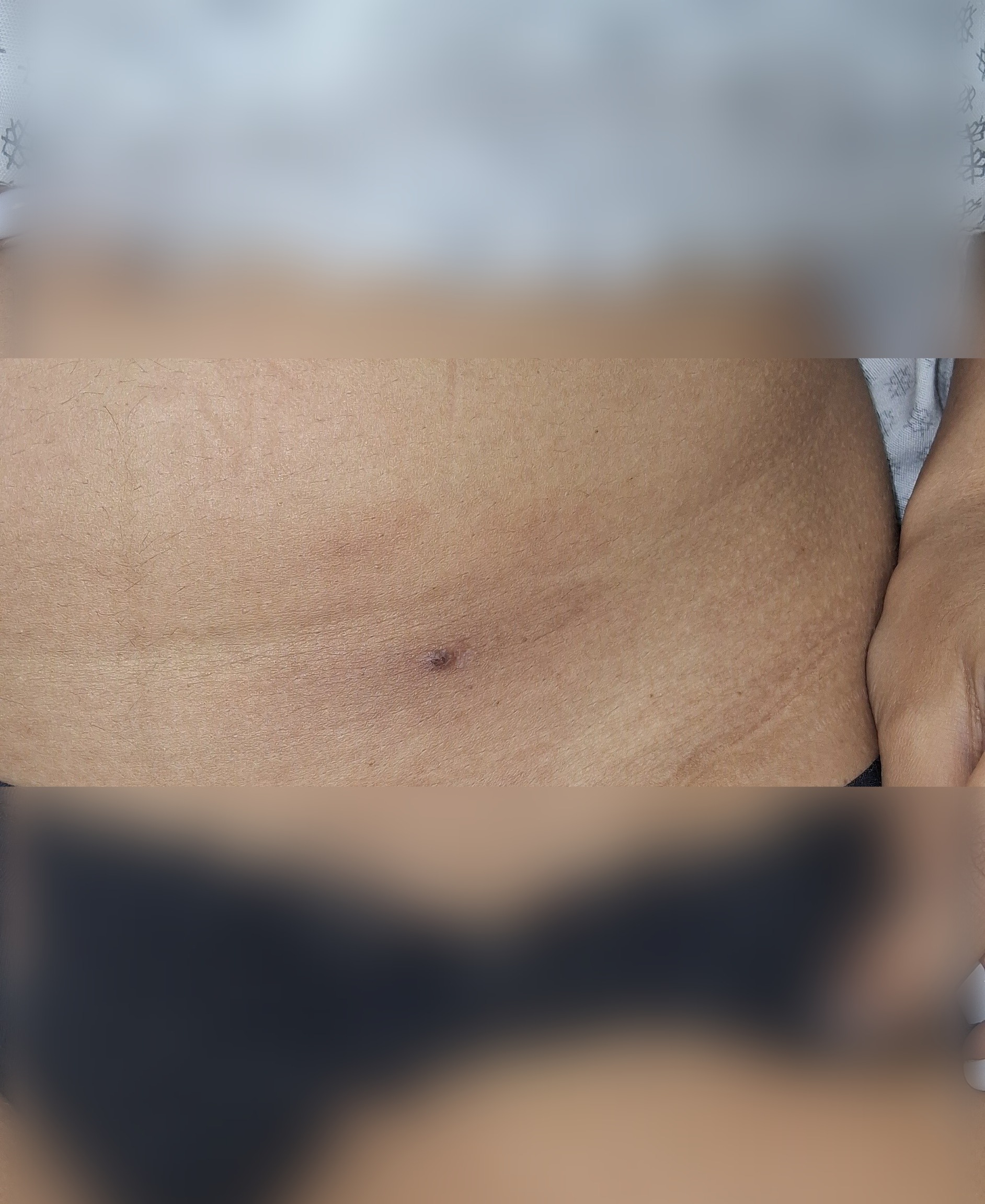 Abscess furuncle: after image