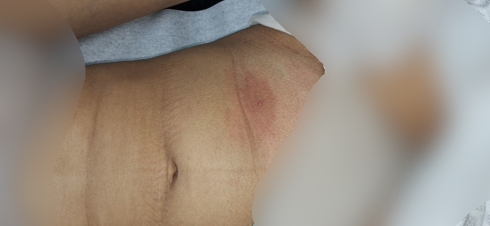 Clinical case: Furuncle abscess