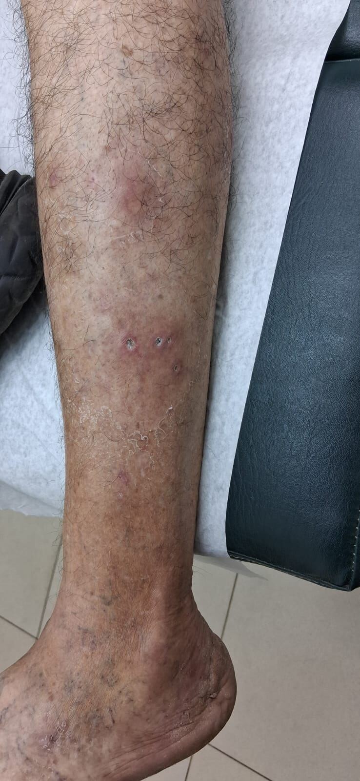 Clinical case: Abscess