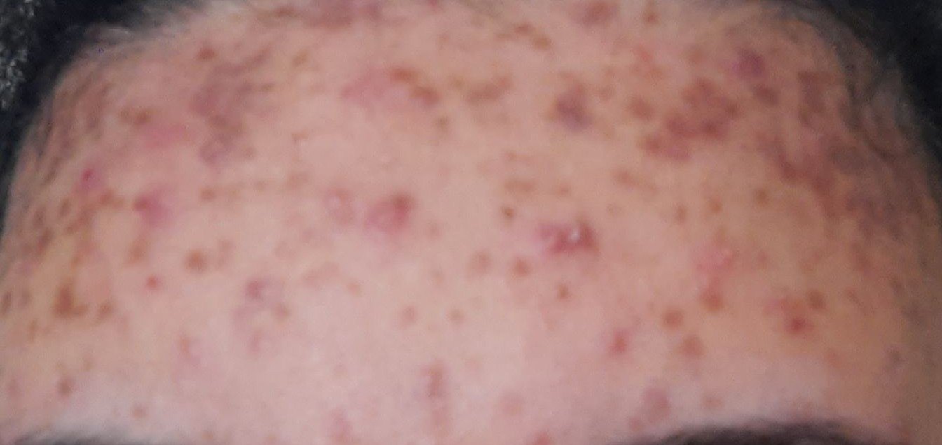 Acne: before image