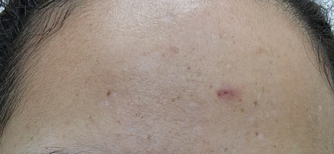 Acne: after image