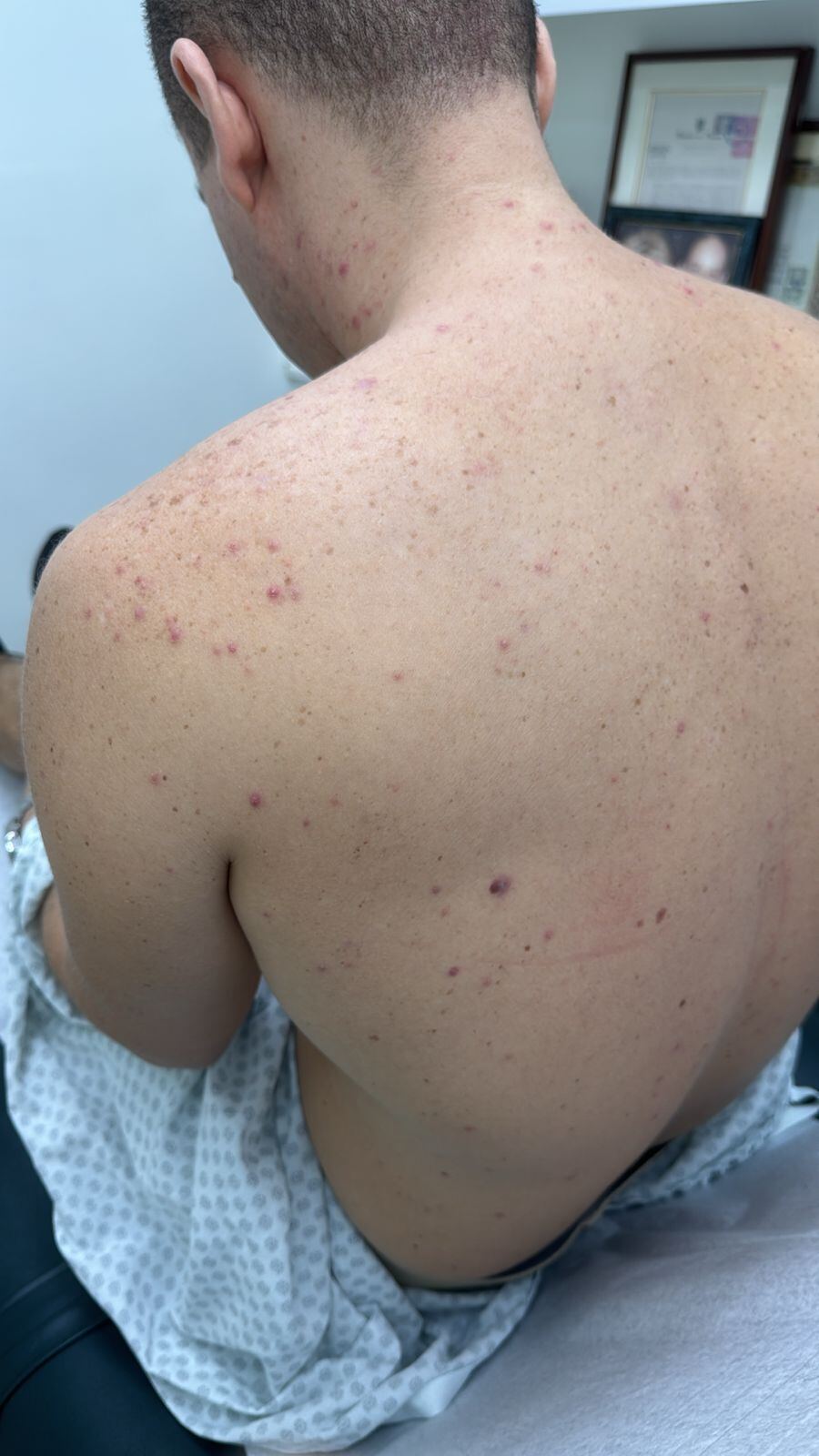 Acne from corticosteroids and B complex: before image