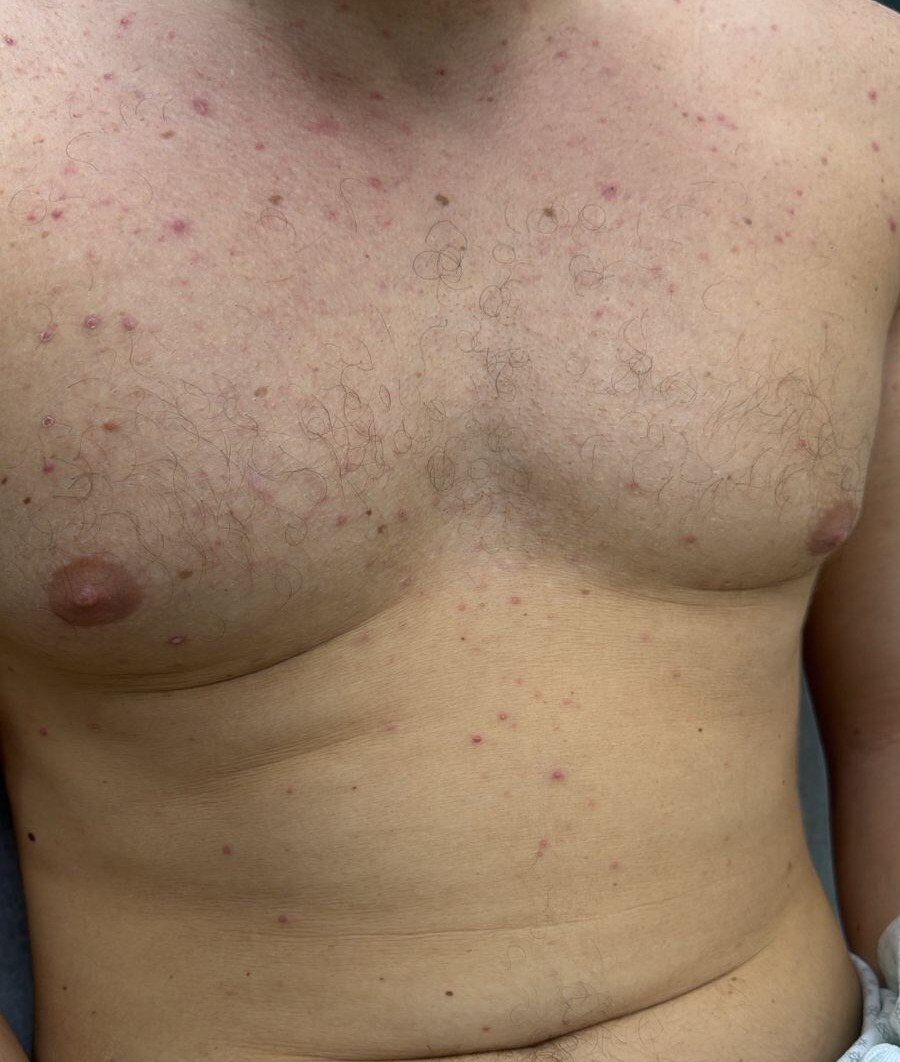 Acne from corticosteroids and B complex: after image