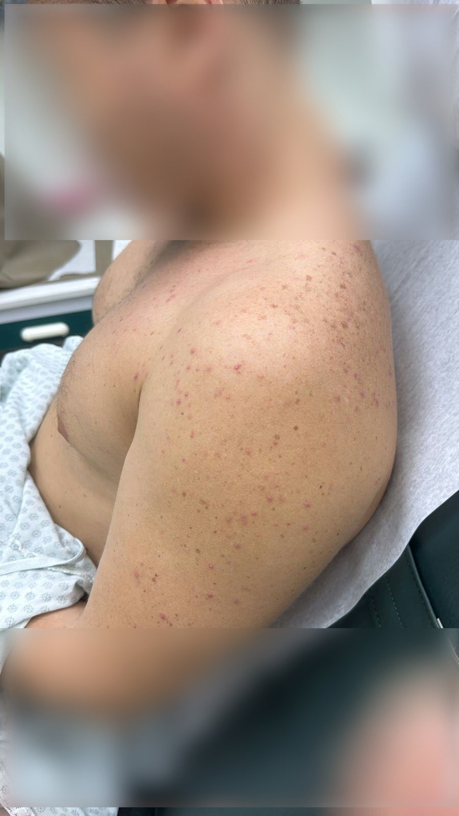 Clinical case: Acne from corticosteroids and B-complex vitamins