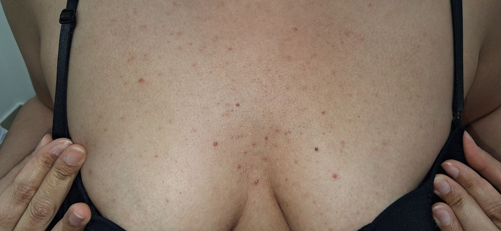 Steroid acne: before image