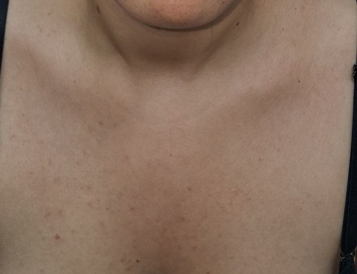 Steroid acne: after image