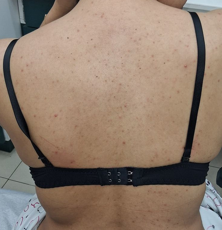 Clinical case of Steroid acne