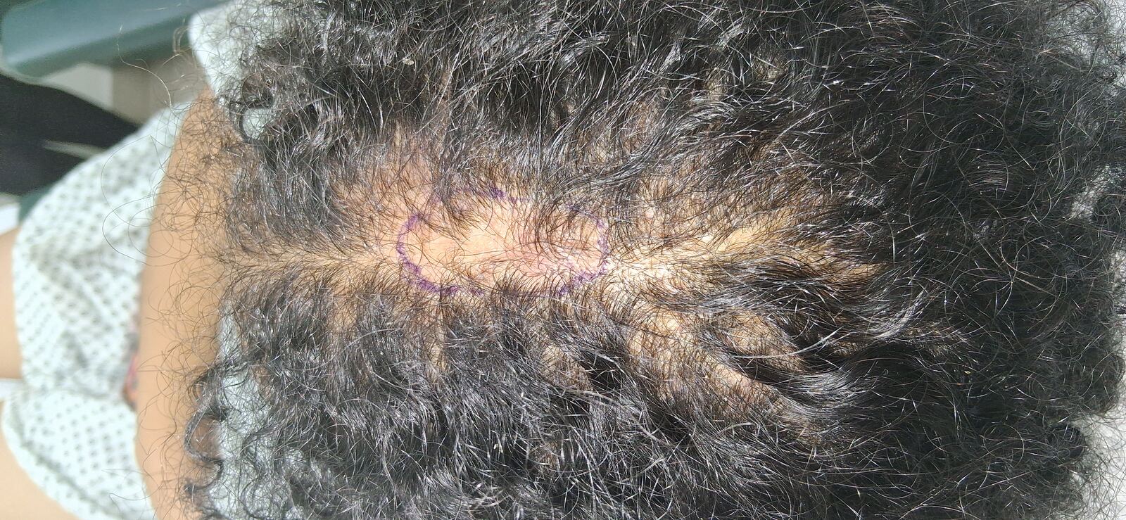 Clinical case: Lymphadenopathy