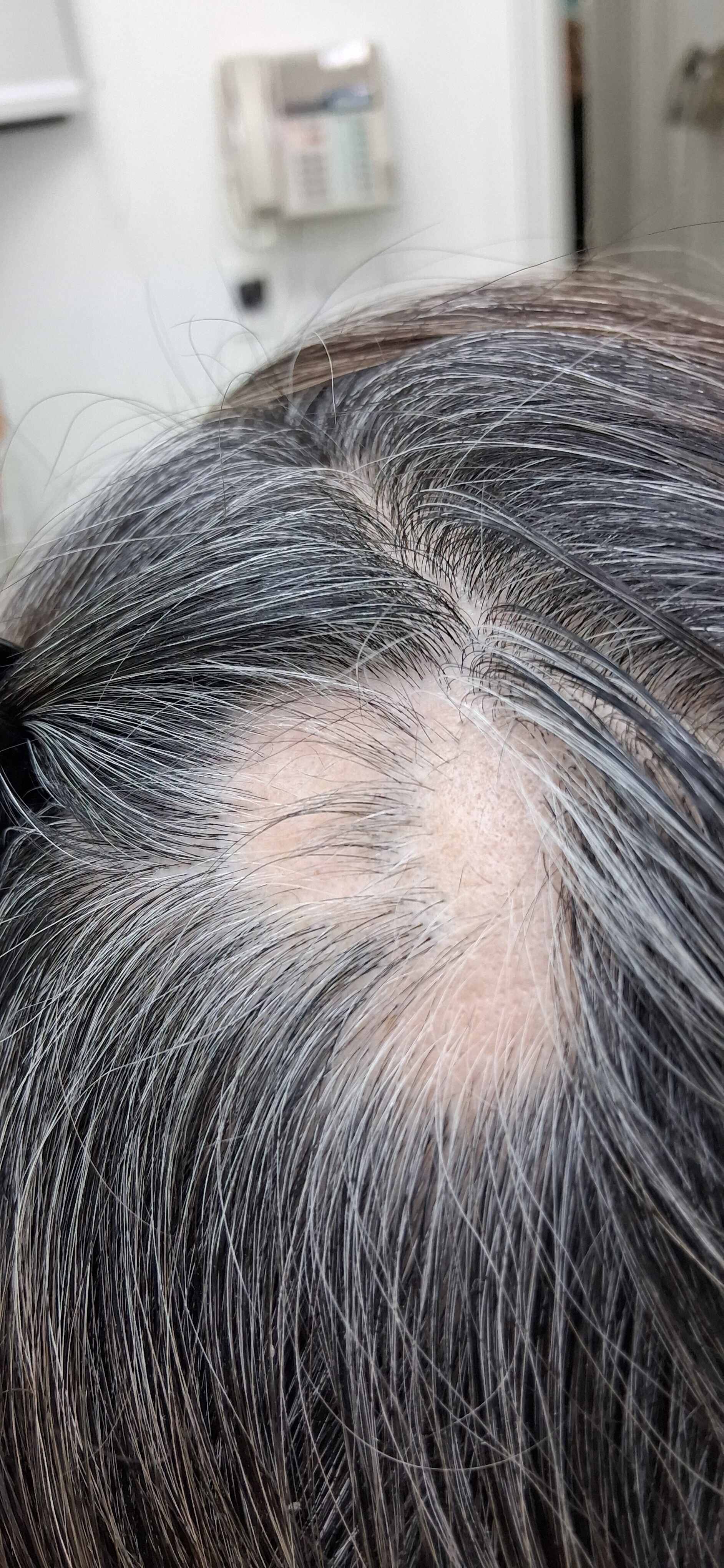 Alopecia areata: before image