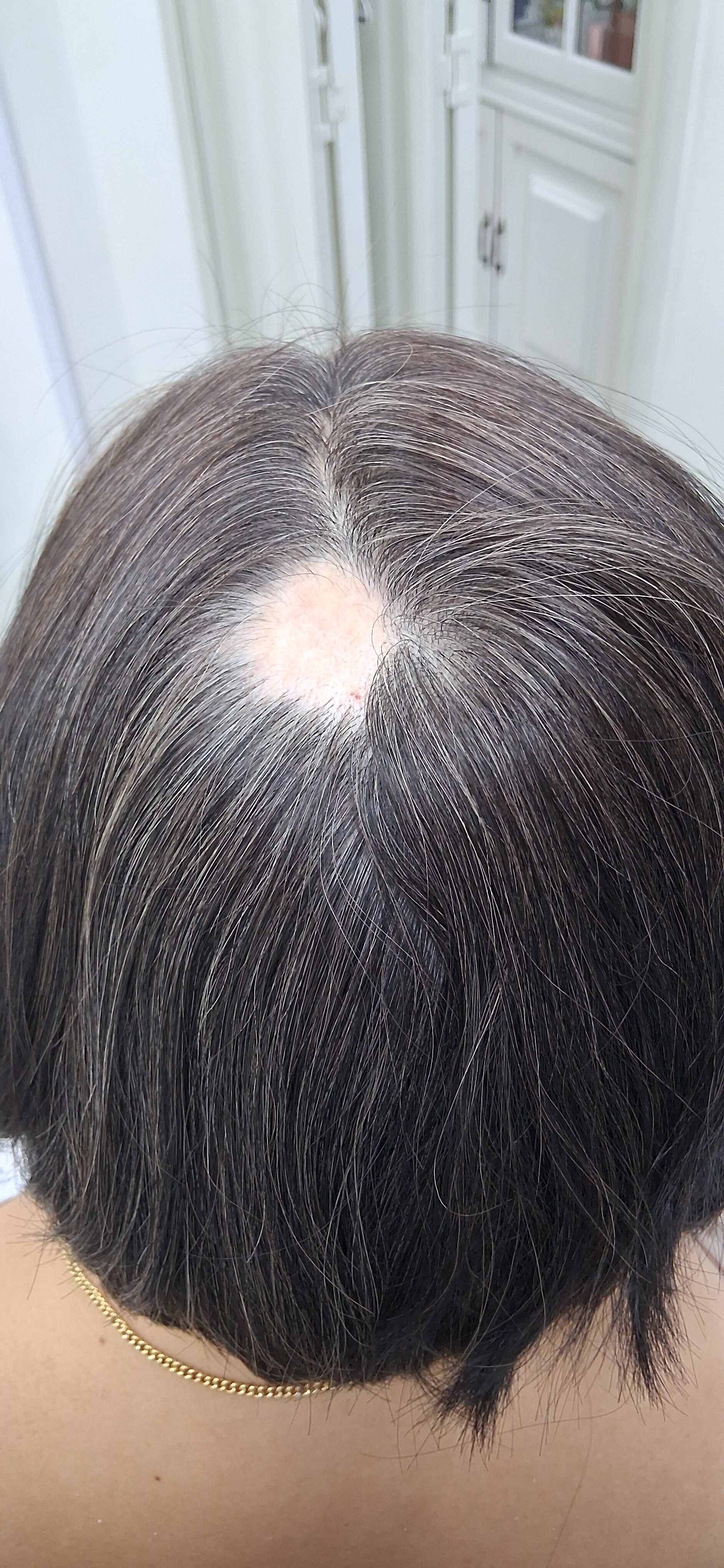 Alopecia areata: after image