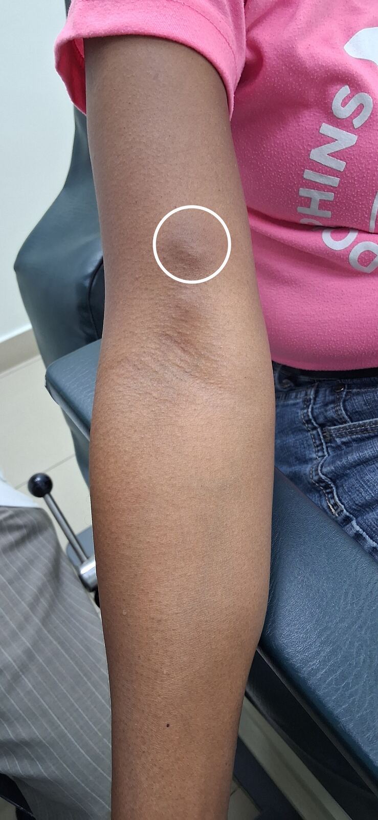 Calcinosis cutis, polymyositis and dermatomyositis: before image