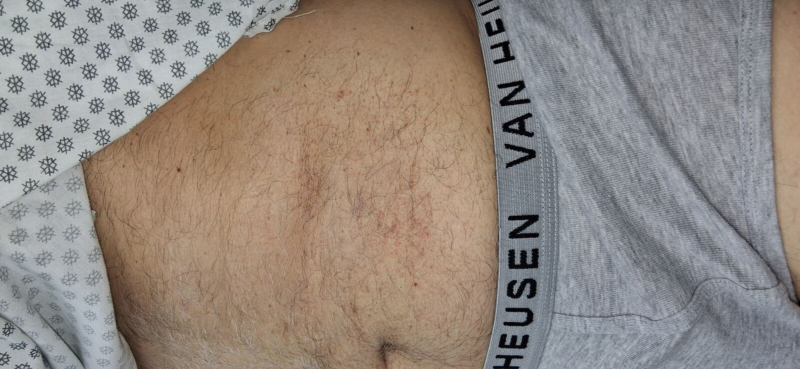 Abdominal capillaritis and xerosis: before image
