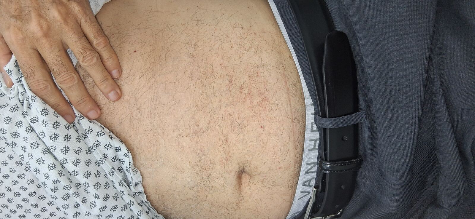 Abdominal capillaritis and xerosis: after image