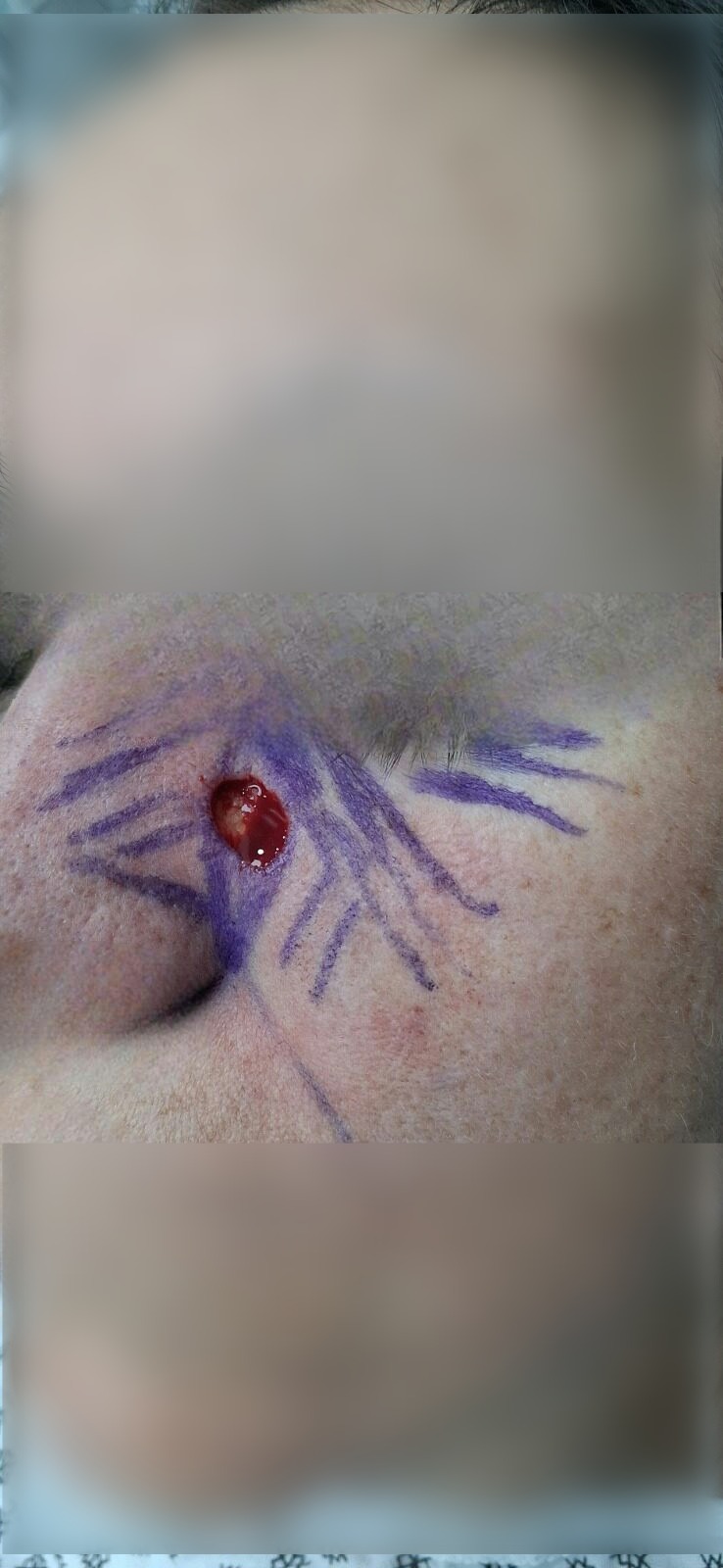 Basal cell carcinoma: before image