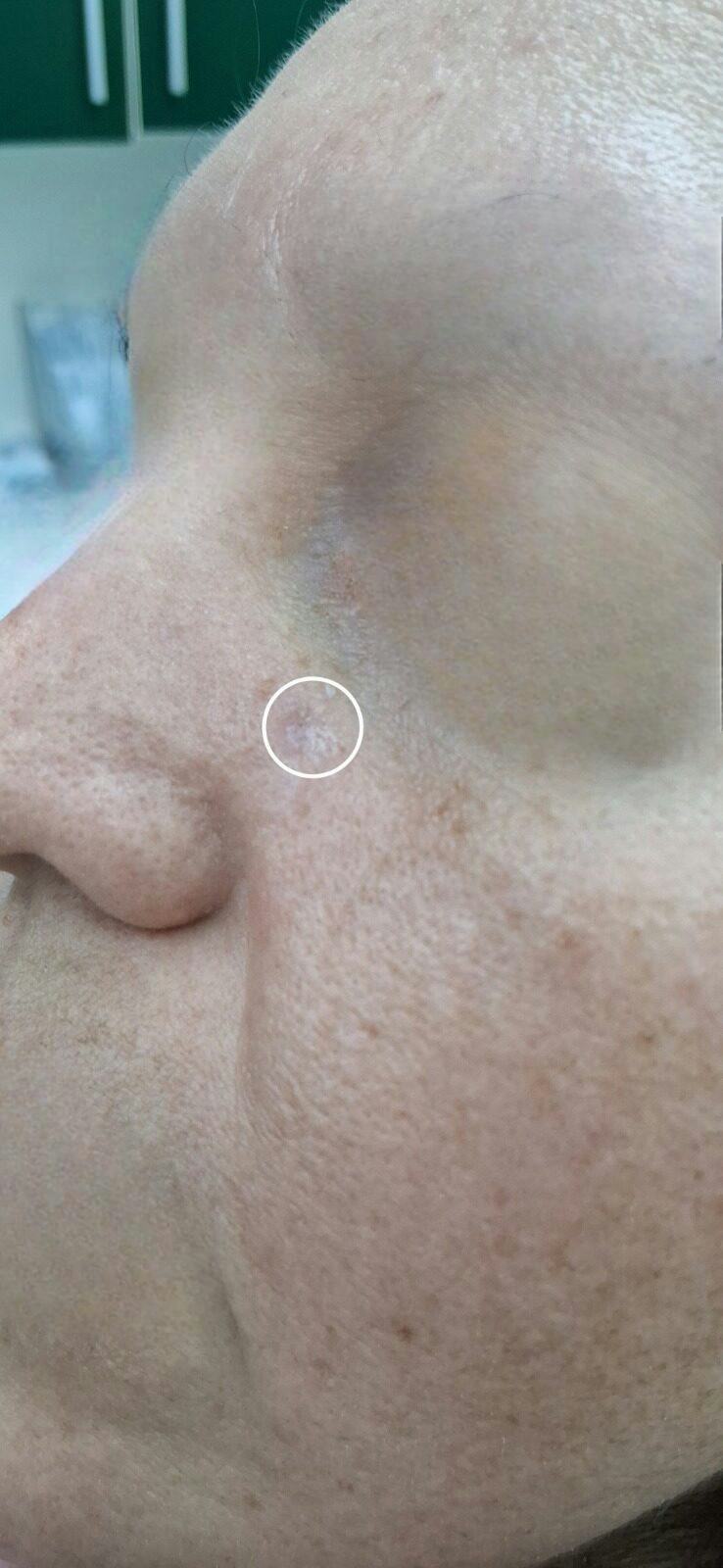 Basal cell carcinoma: after image