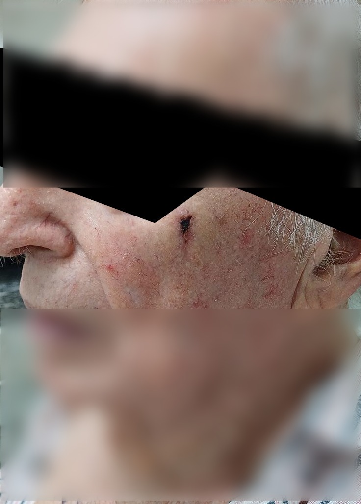 Squamous cell carcinoma: before image