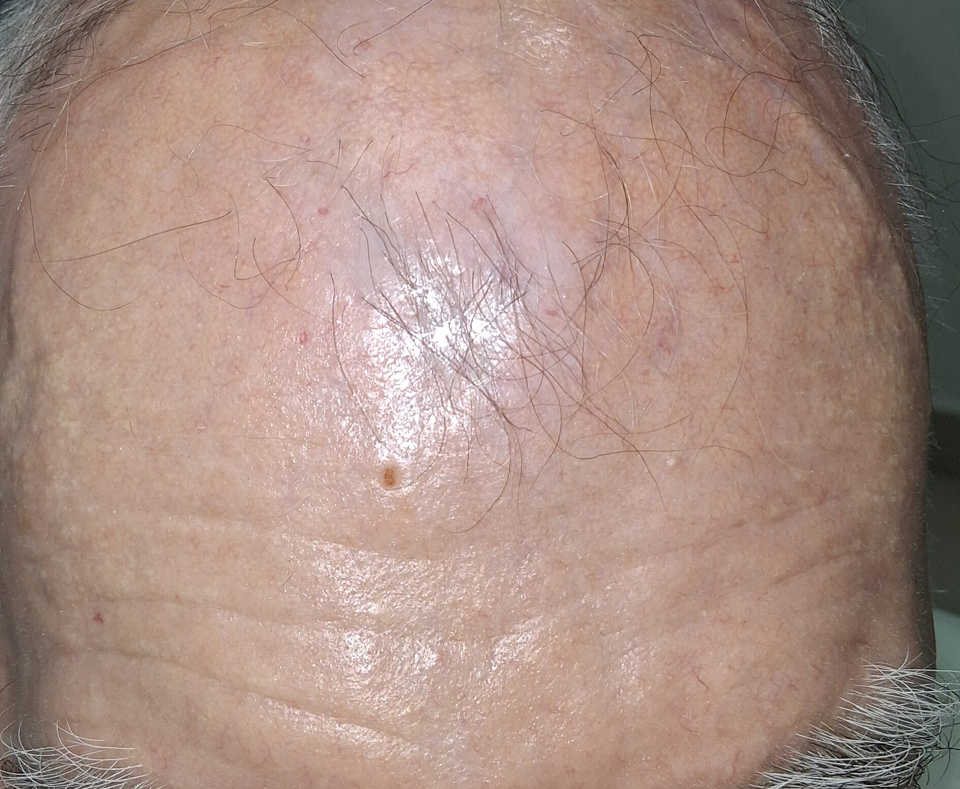 Squamous cell carcinoma: after image