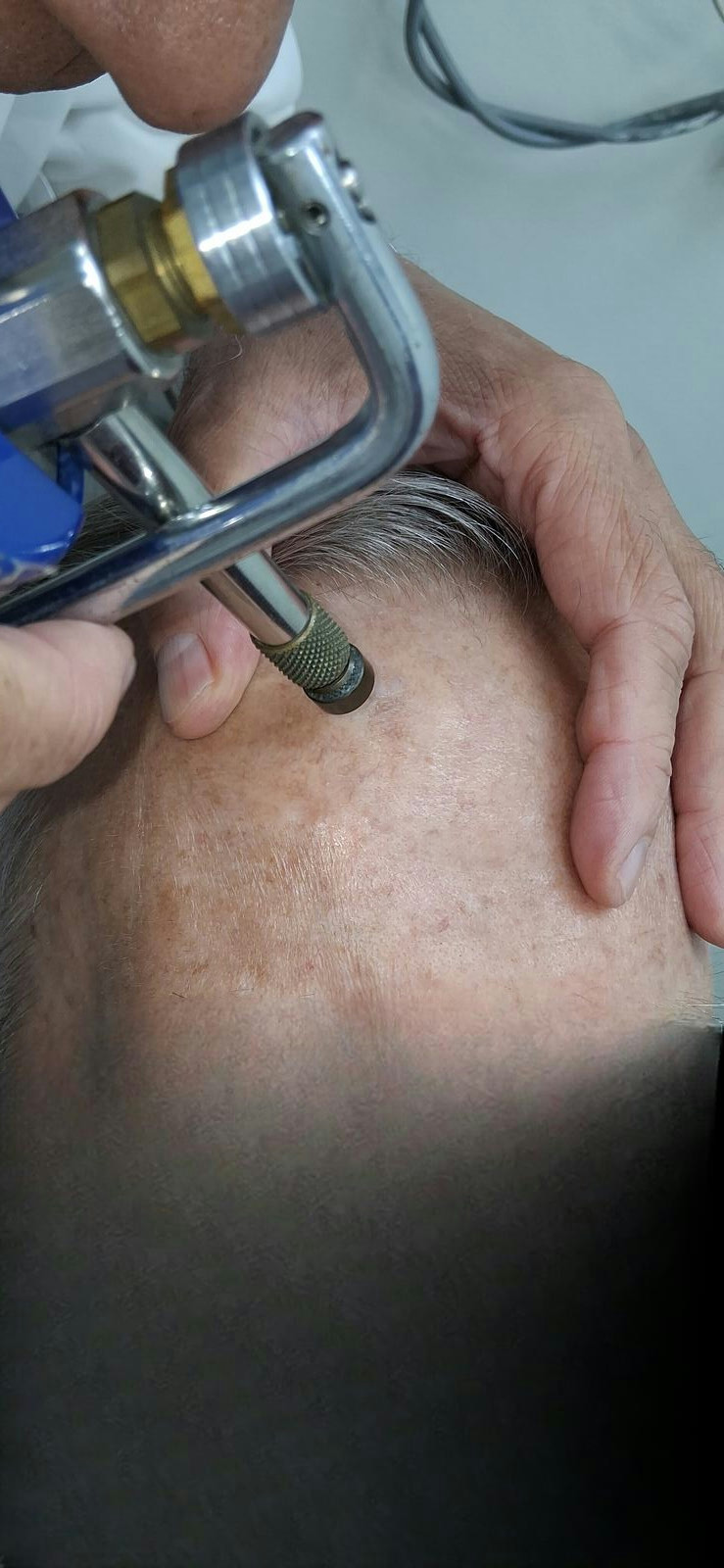 Squamous cell carcinoma in situ: before image