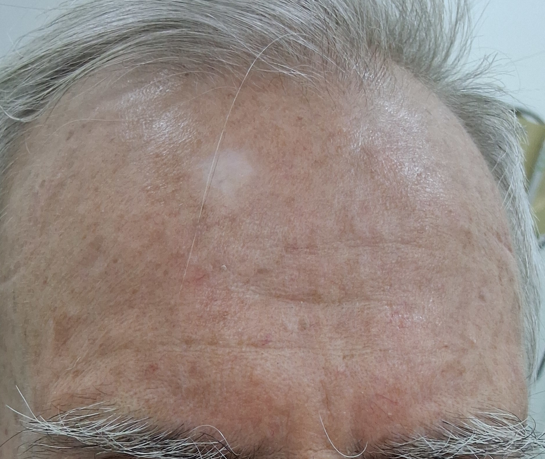 Squamous cell carcinoma in situ: after image