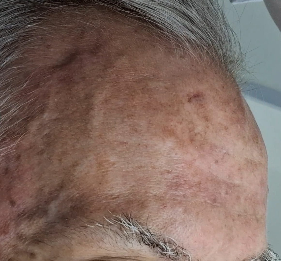 Clinical case: Squamous cell carcinoma in situ