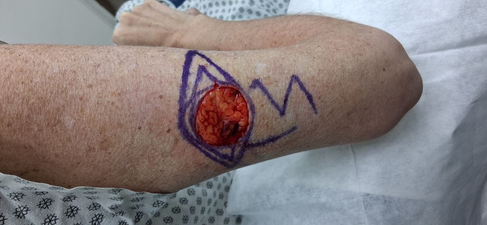 Squamous cell carcinoma vs basal cell carcinoma: after image