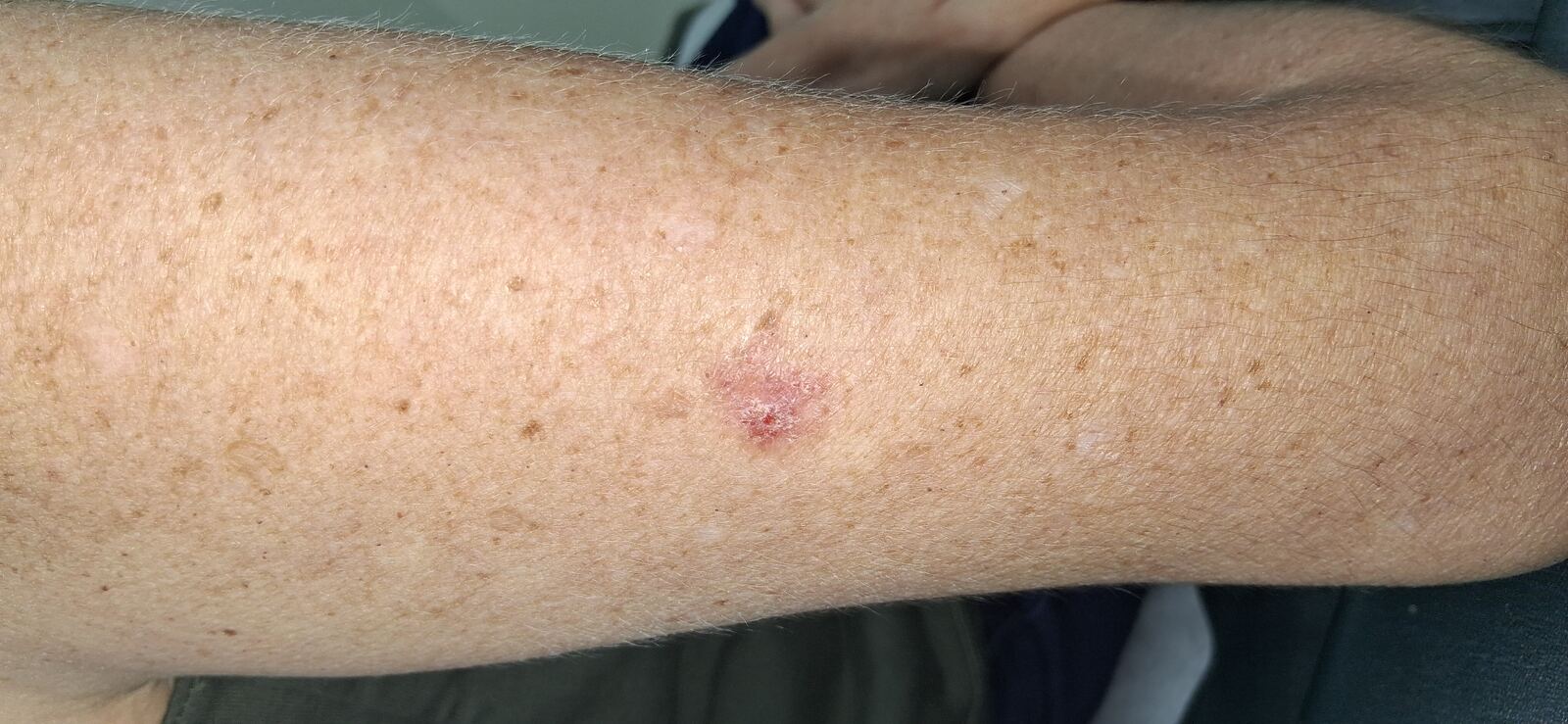 Clinical case: Squamous cell carcinoma vs basal cell carcinoma