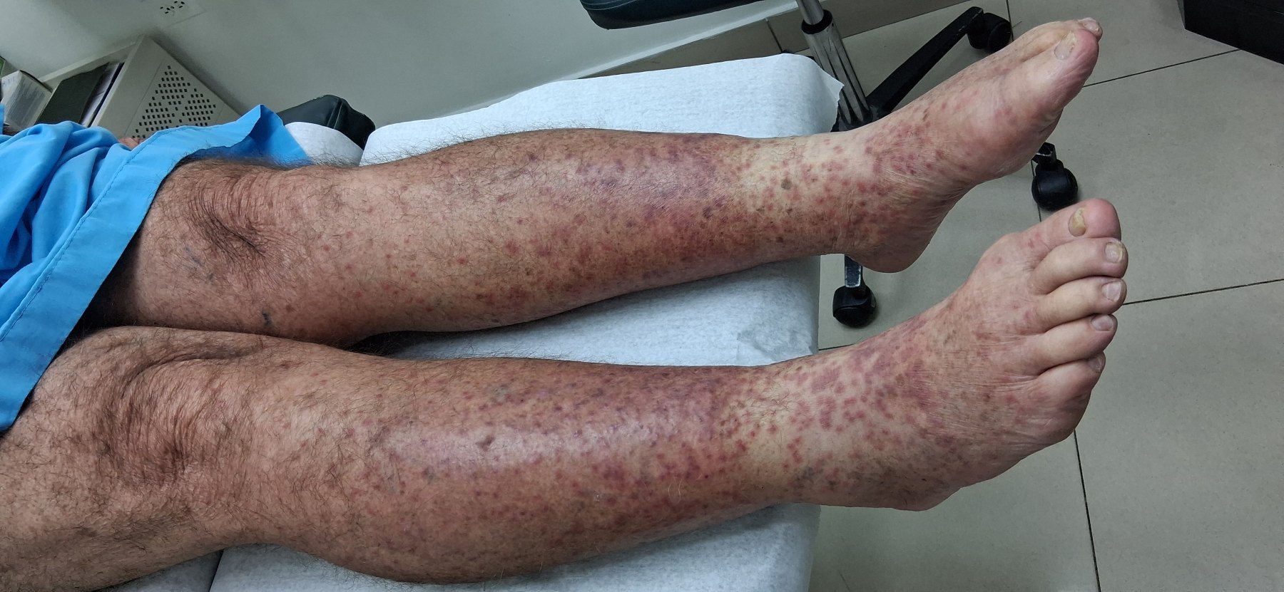 Cellulitis: before image