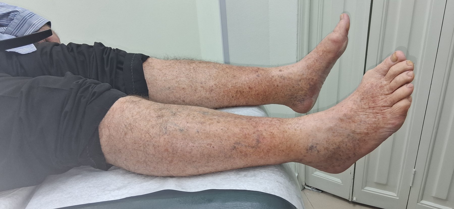 Cellulitis: after image