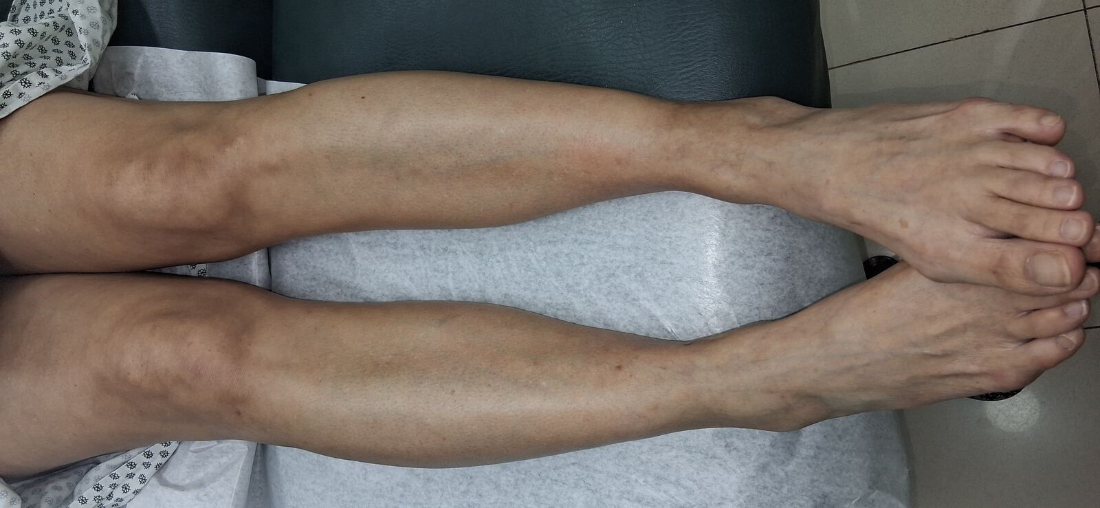 Clinical case: Cellulitis