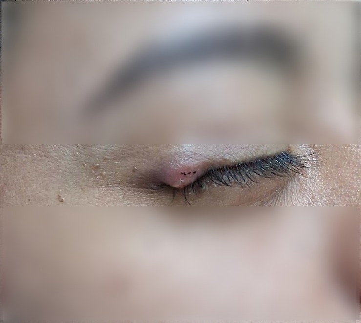 Chalazion: before image