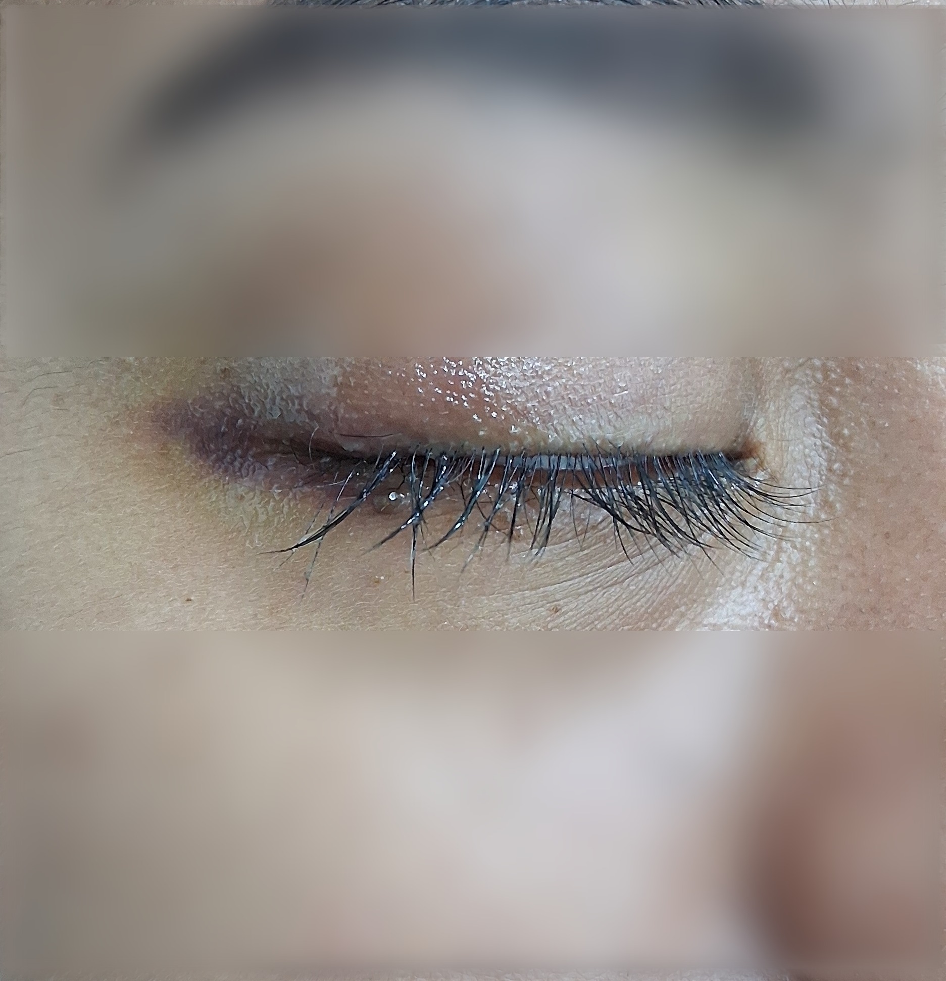 Chalazion: after image