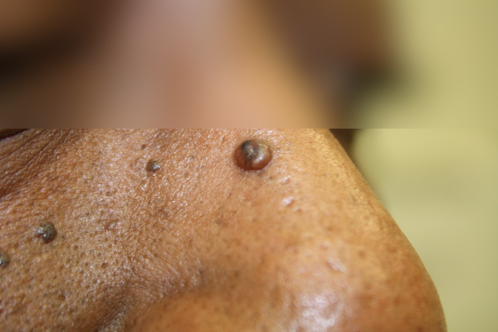 Clinical case: Mohs surgery with microscopic control