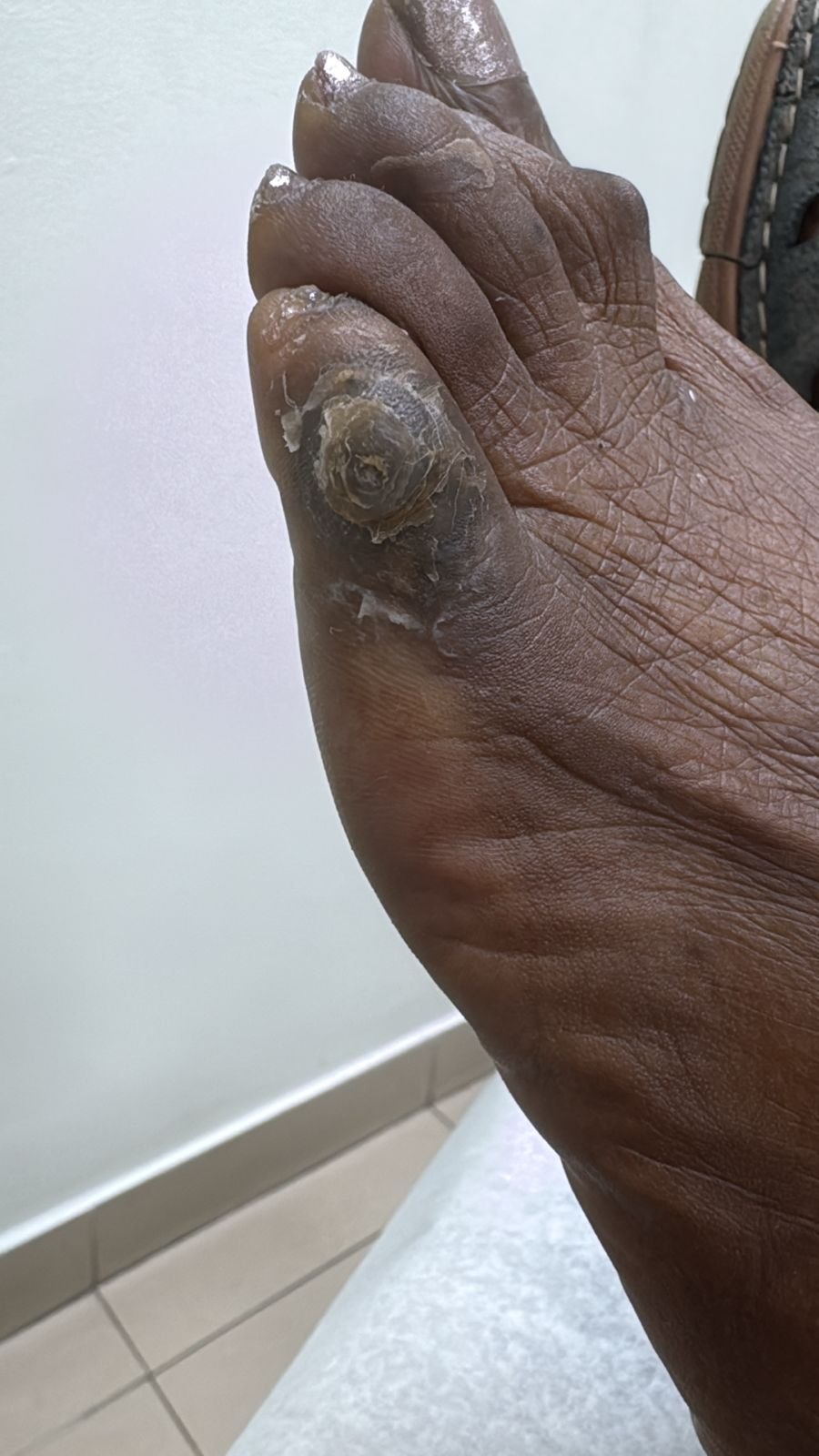 Clinical case of Clavus (callus)