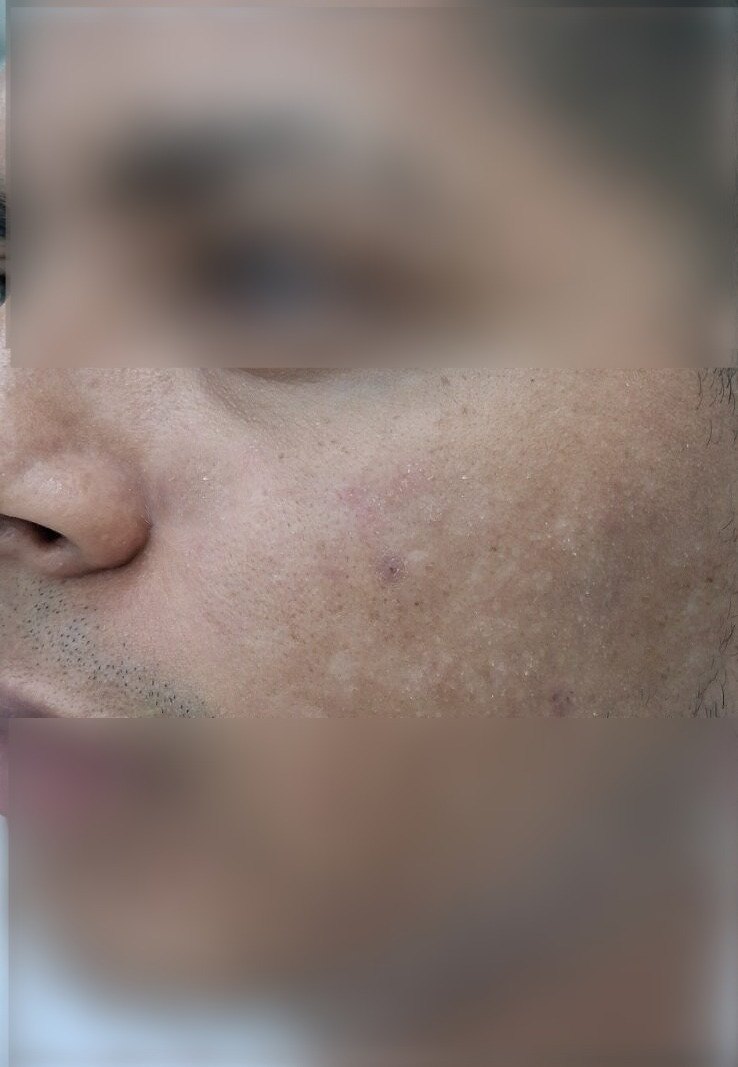 Demodex: before image