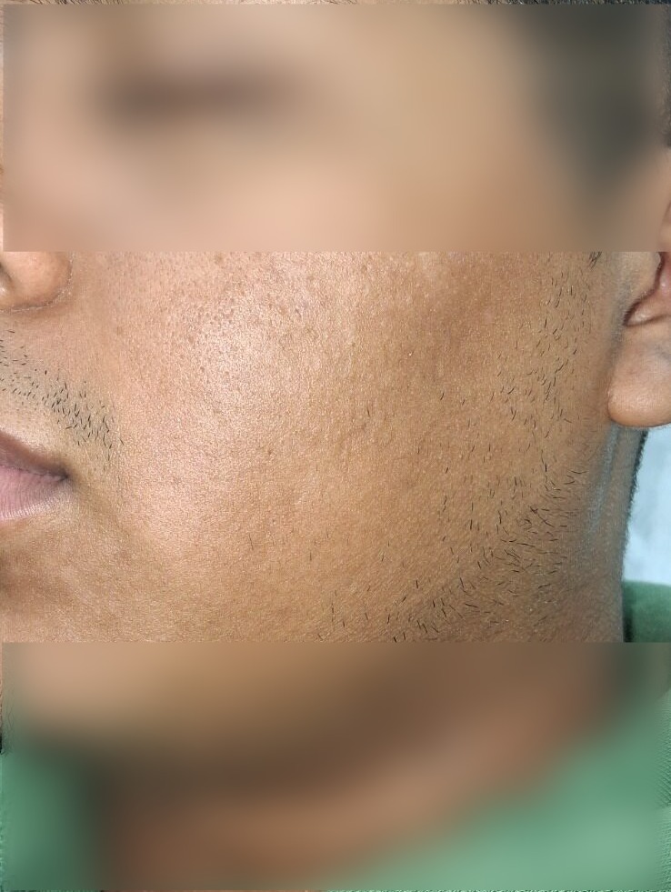 Demodex: after image