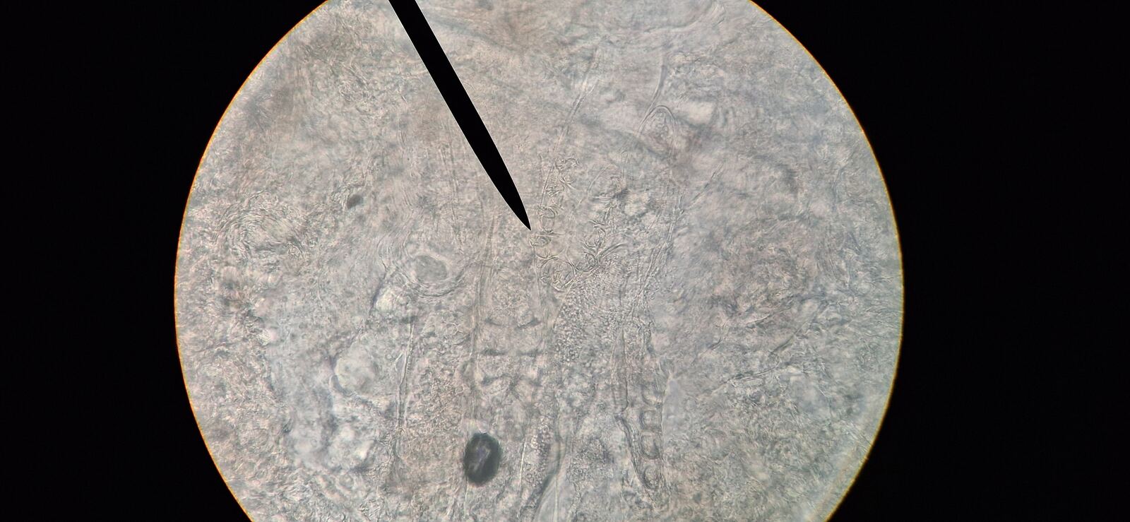 Demodex and seborrheic dermatitis: before image