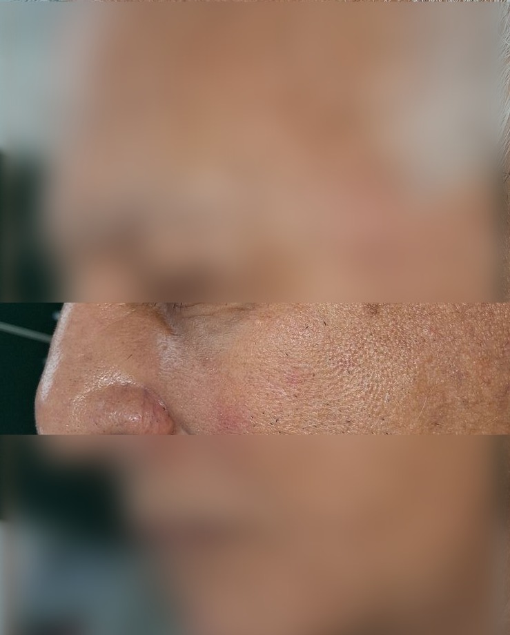Demodex and seborrheic dermatitis: after image