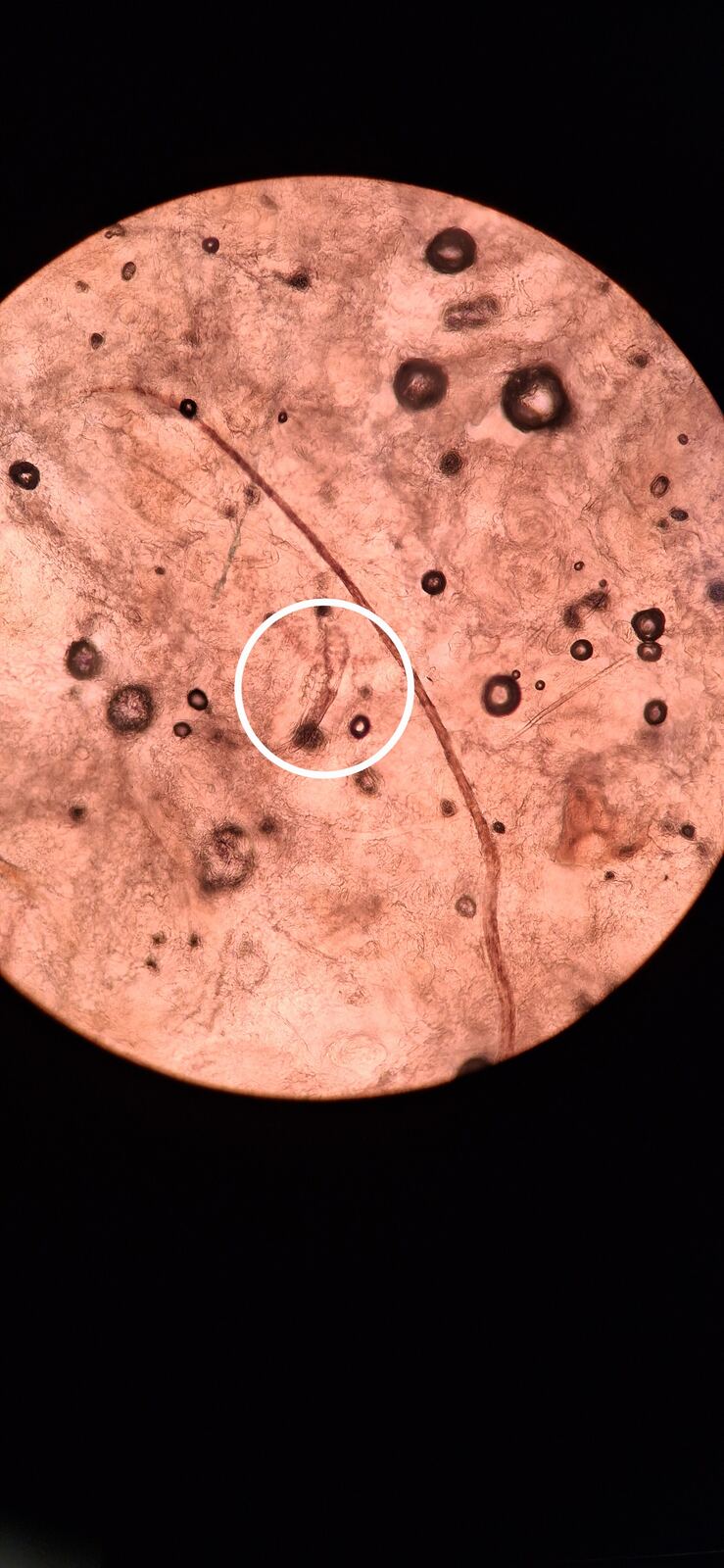 Demodex and rhinophyma: before image