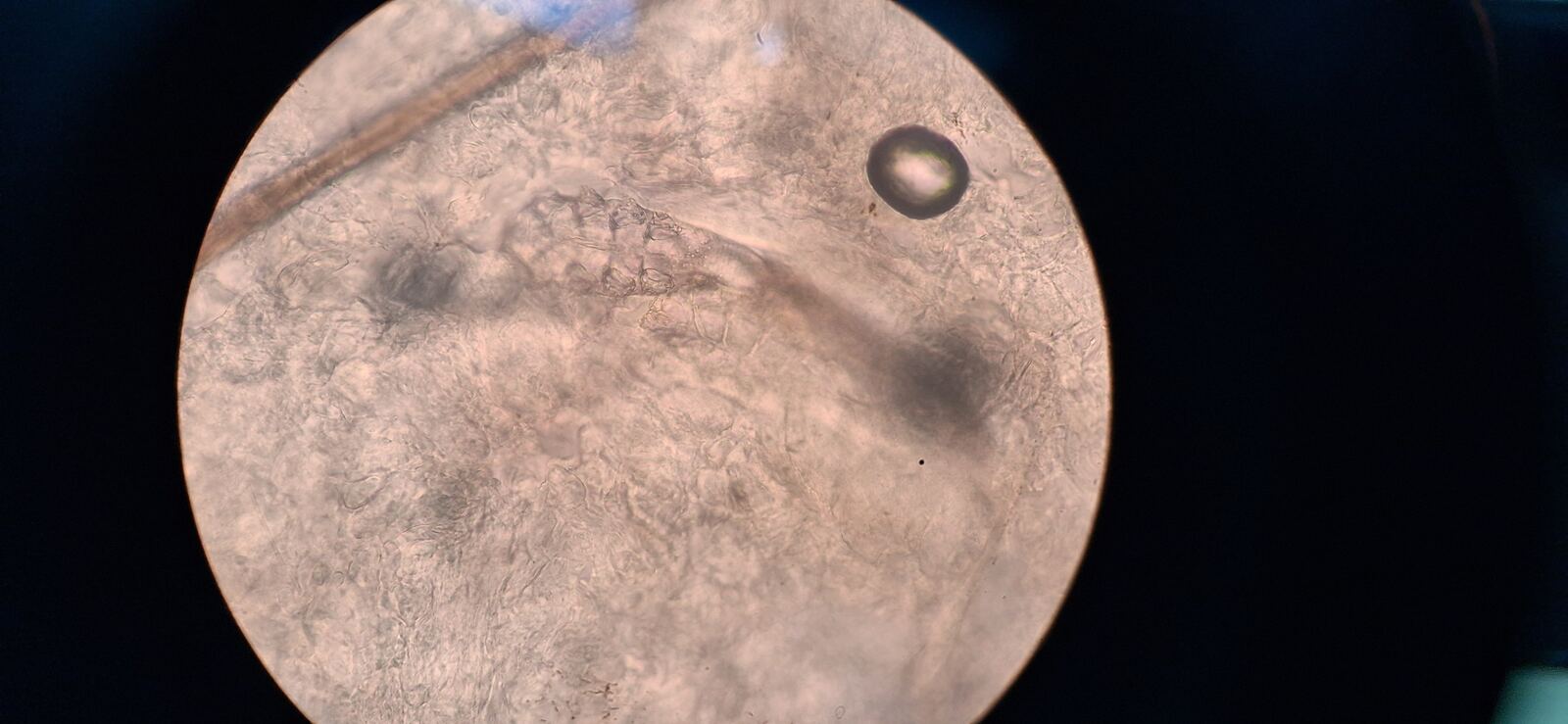 Demodex and rhinophyma: after image