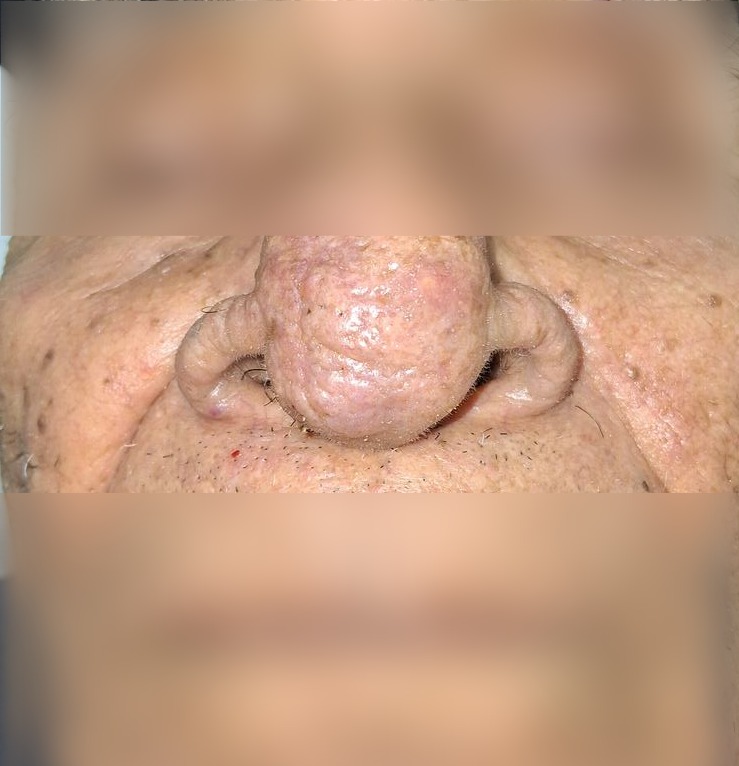 Clinical case: Demodex and rhinophyma