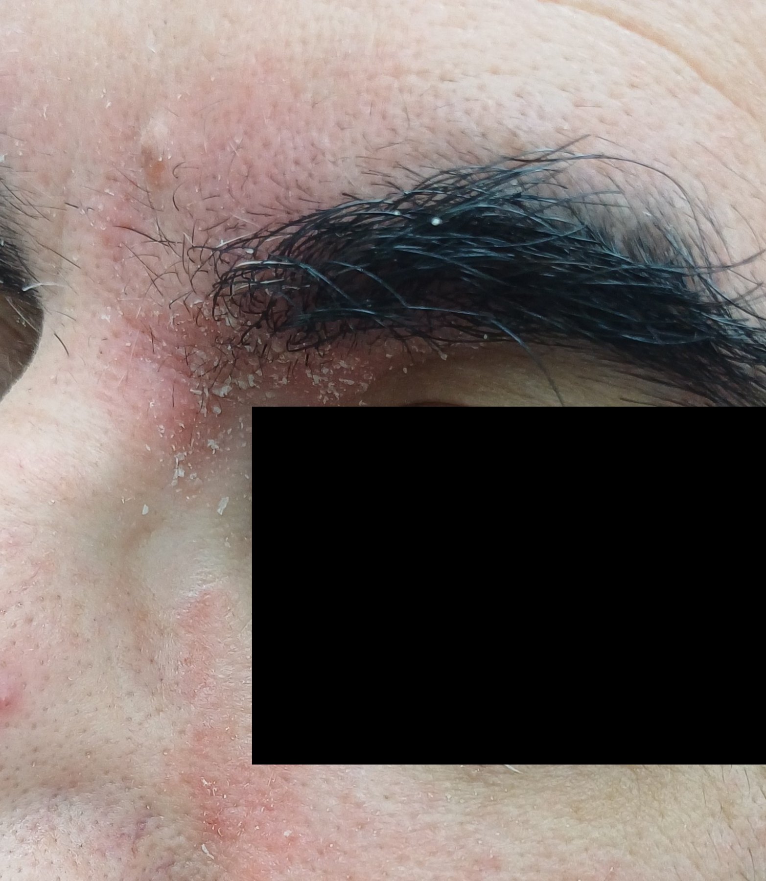 Demodex and rosacea: before image