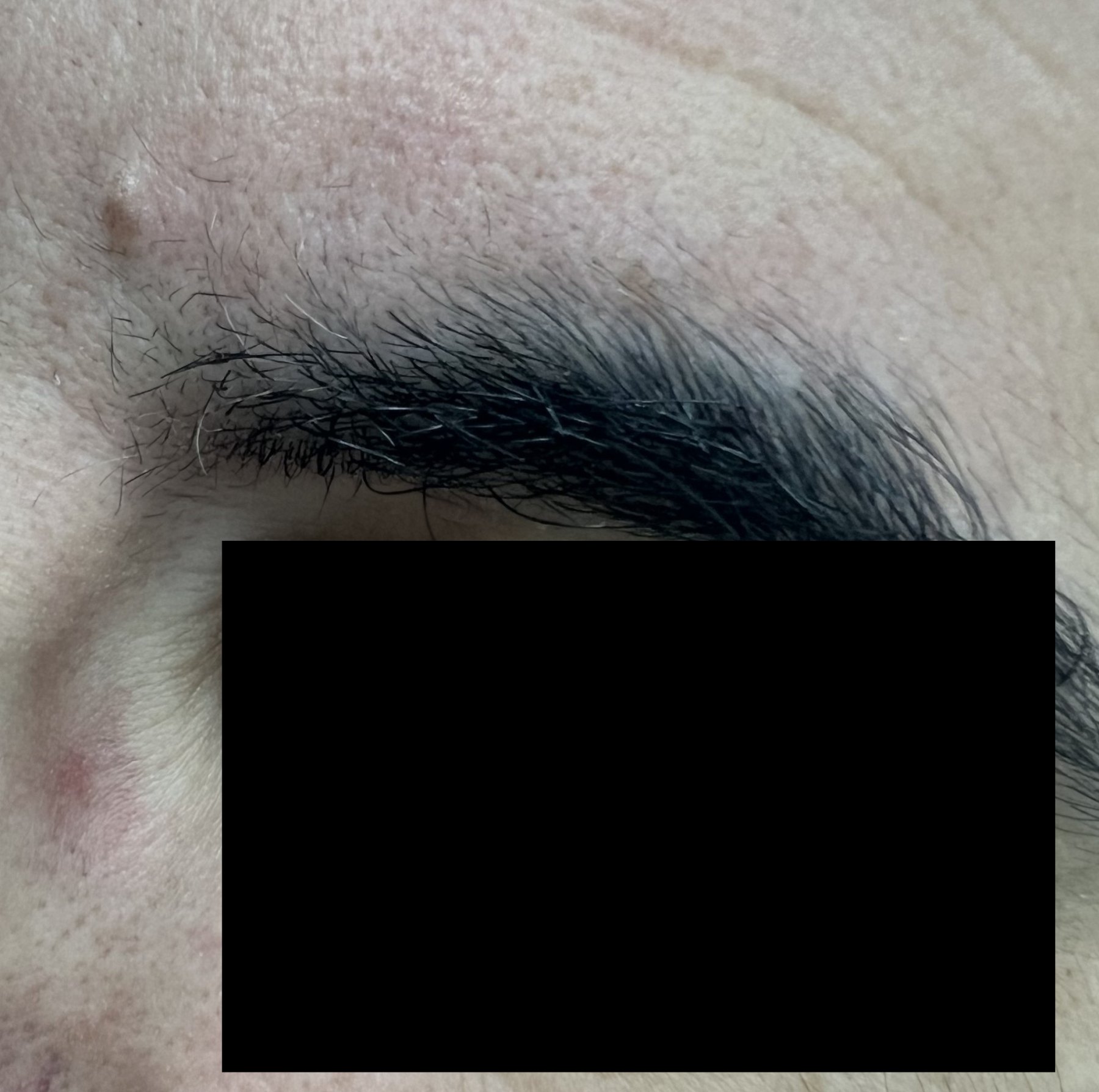 Demodex and rosacea: after image