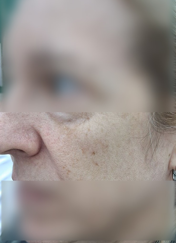 Clinical case: Demodex and rosacea