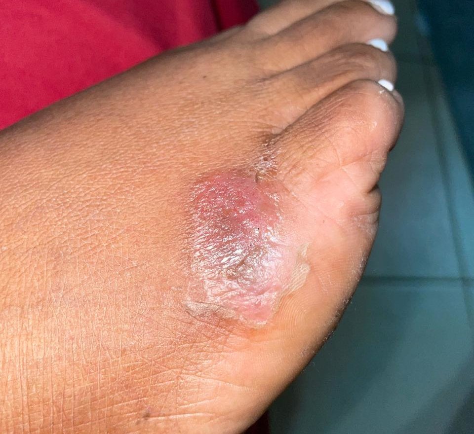 Dermatitis: before image