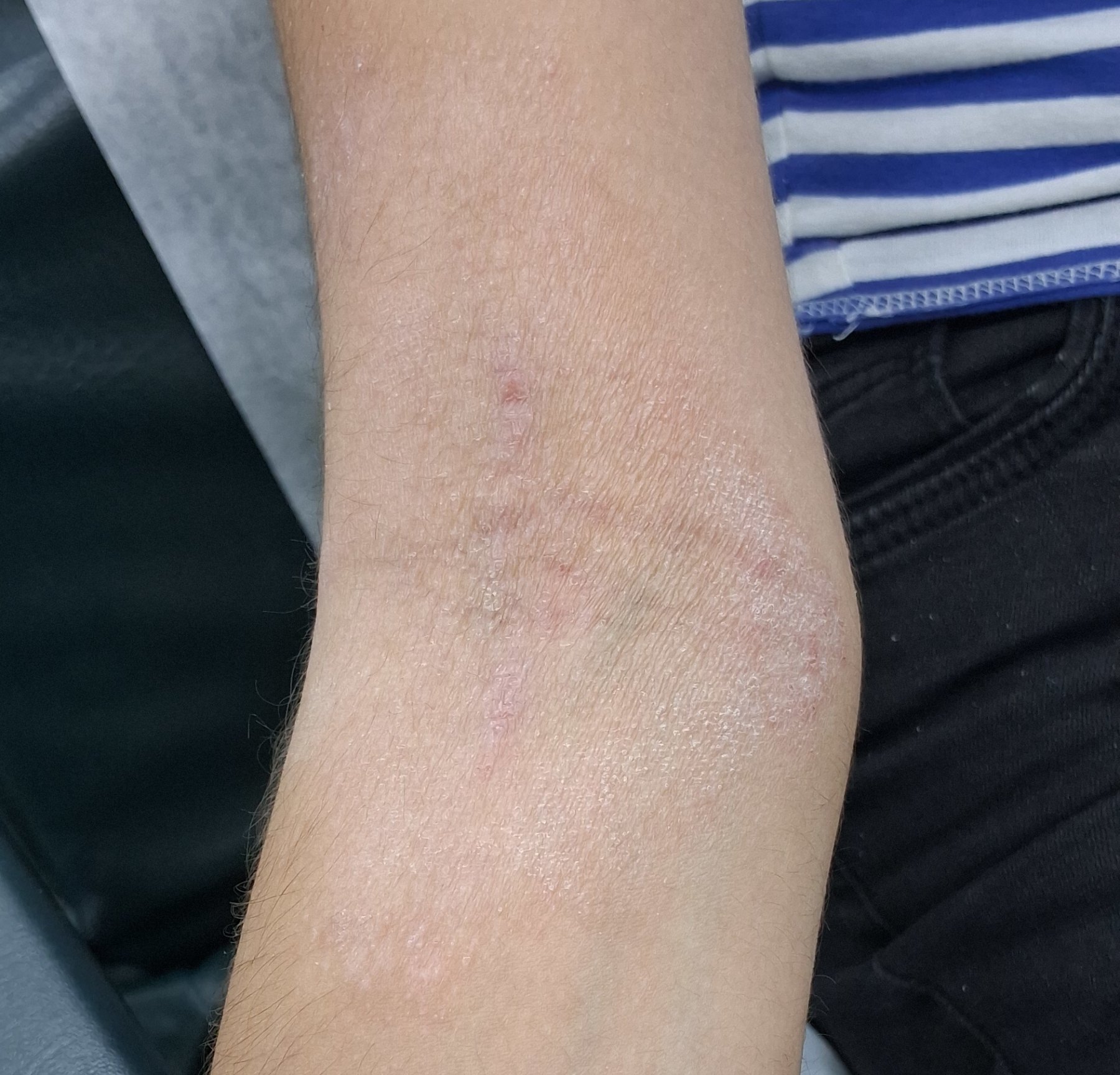Atopic dermatitis: before image