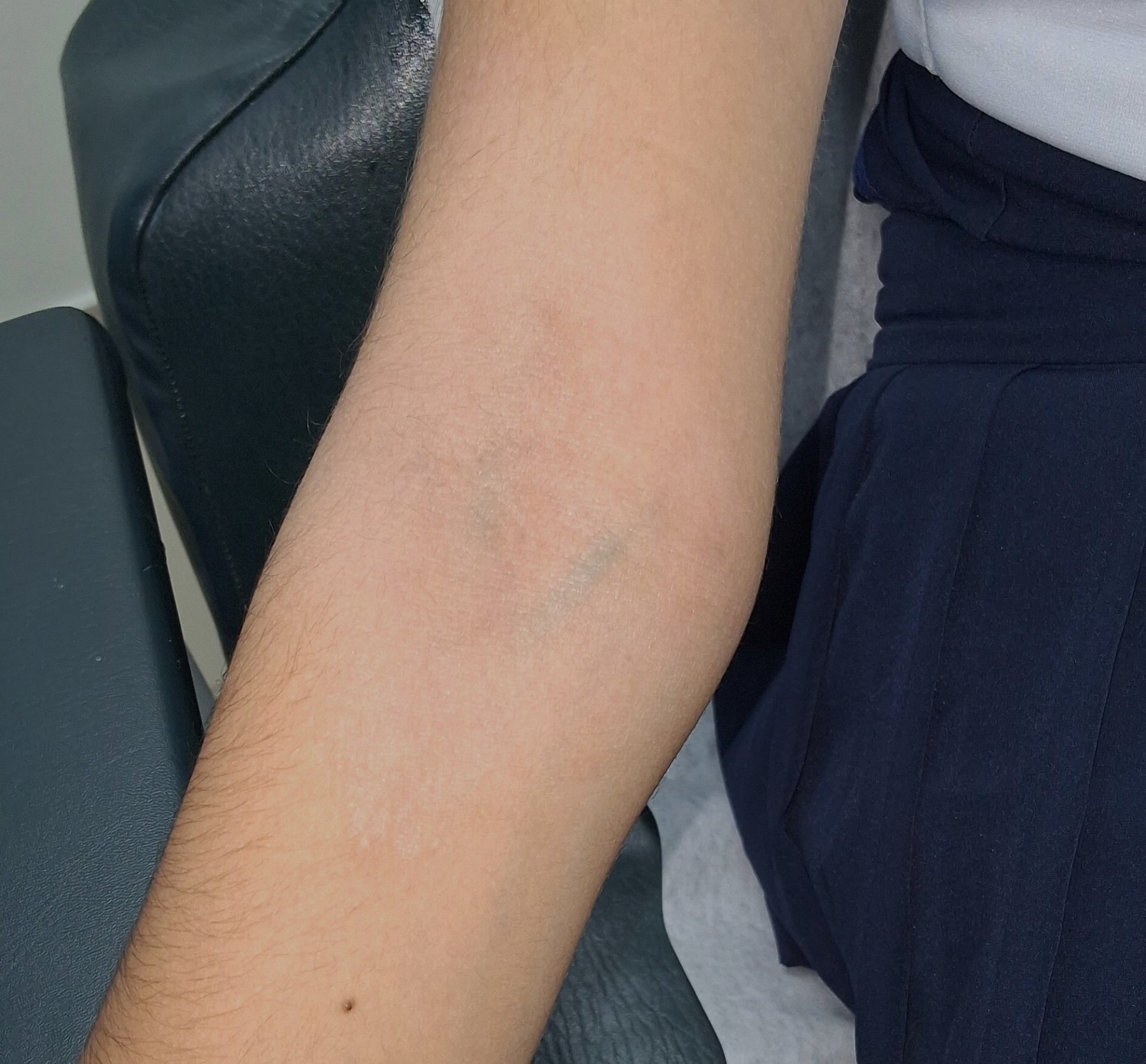 Atopic dermatitis: after image