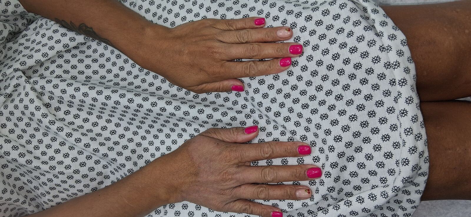 Clinical case: Atopic dermatitis